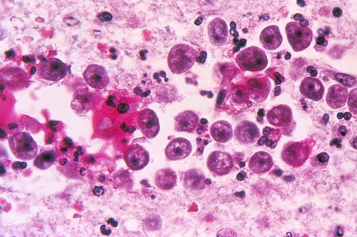 Reemergence of deadly brain-eating amoeba sets off alarms